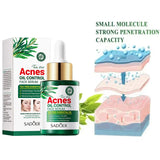 Tea Tree Oil Moisturizer Face Body Skin Care Reducing Acne Scars Repair Facial Serum Oil Control Pores Shrinking Clear Skin