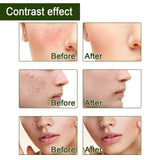 10ml Tea Tree Essential Oil Compound Plant Hydrating Oil-control Remove Pore Anti-acne Moisturizing Brighten Face Skin Care